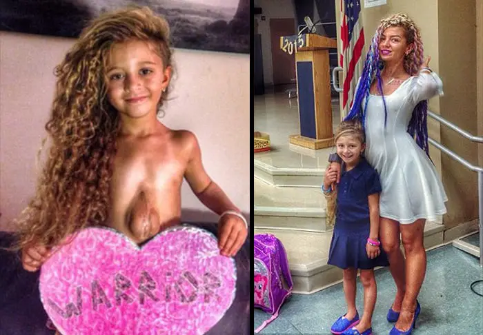 Meet-Virsaviya-‘Bathsheba’-Borun-Goncharova-The-Six-Year-Old-Girl-Born-With-Her-Heart-Outside-Her-Chest-