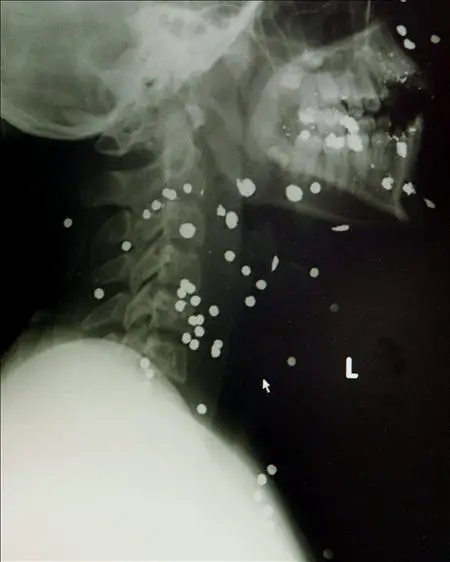 11-radiografias-esquirlas