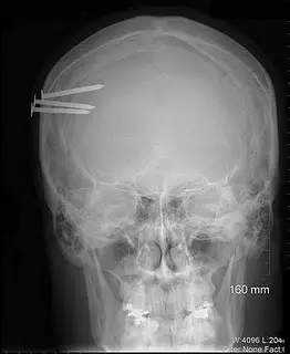 19-radiografia-clavos-cabeza