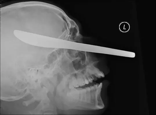 21-radiografia-cuchillo