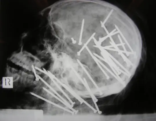 Police handout image of an X-ray showing multiple nails embedded of the skull of 27-year-old Chen (Anthony) Liu