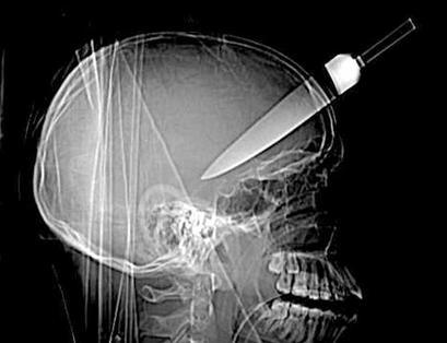 6-radiografia-cuchillo-en-la-cabeza