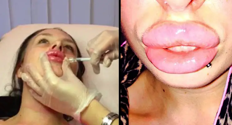 Pensativo tal vez Abrazadera 14 Fotos que muestran el aspecto de una VÍCTIMA del exceso de silicona en  los labios ¡TERRIBLE! | Difundir.ORG