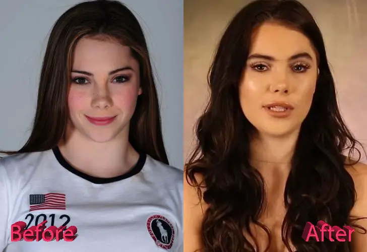Mckayla-Maroney-Before-and-After-Lip-Job