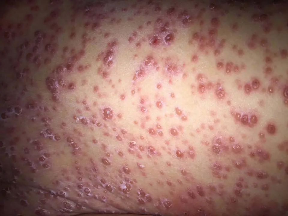 WORST EVER CHICKEN POX AFTER MUM TURNED AWAY