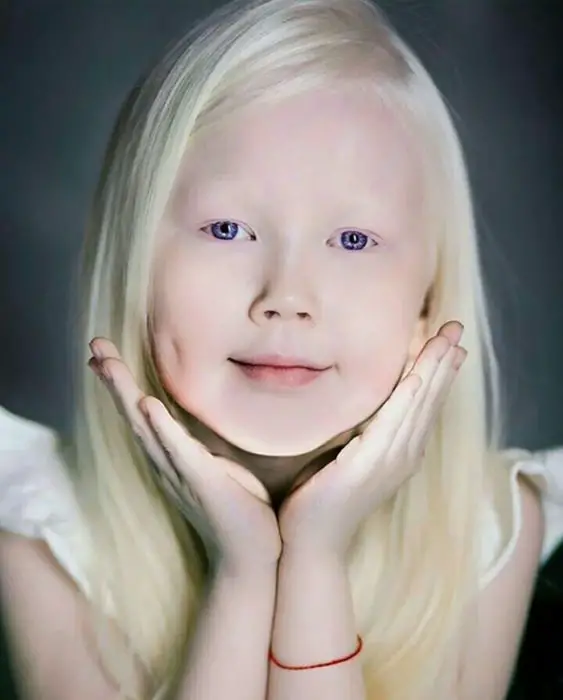 Niña-albina-3-563x700