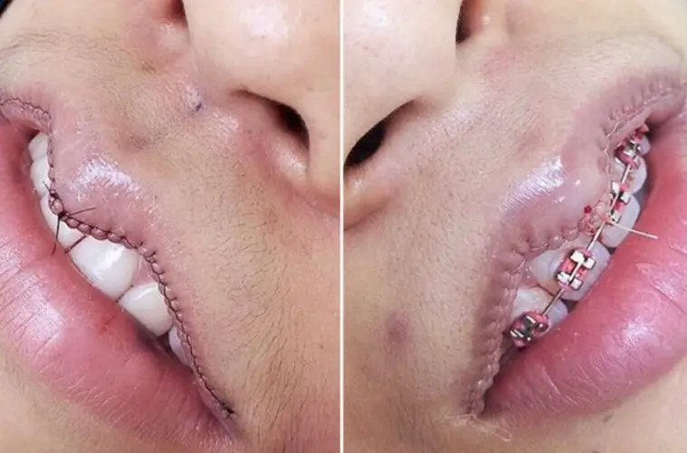 lipsurgery-759x500