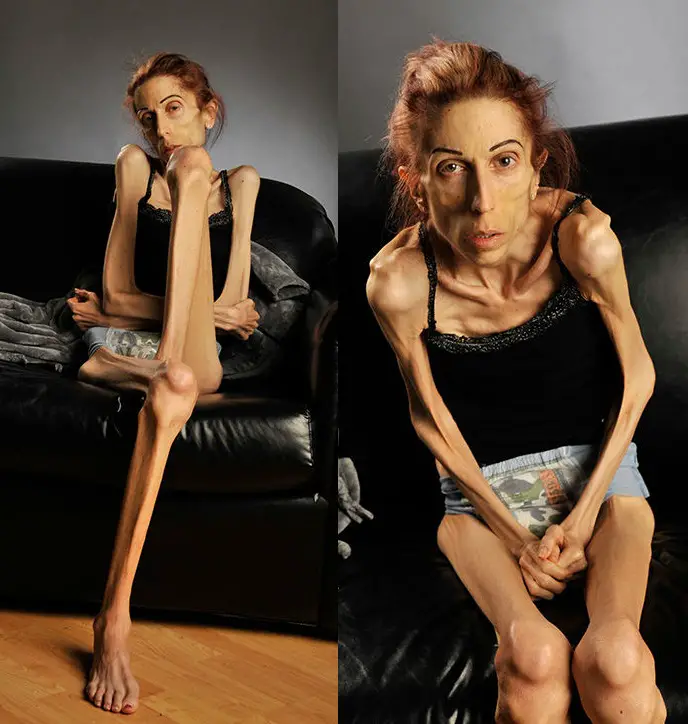 Recuerdas El Peor Caso De Anorexia Del Mundo Dio Un Gran Cambio Y As Luce En La Actualidad